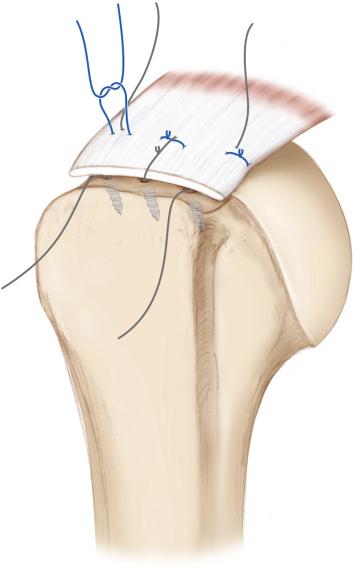 FIG. 19.1, The single-row rotator cuff repair using the modified Mason-Allen suture-grasping technique: once the sutures are passed through the tendon creating a horizontal mattress stitch with a perpendicularly overlying simple stitch, the sutures are tied starting with the mattress stitch.