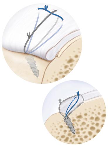 FIG. 19.2, The modified Mason-Allen suture-grasping technique is composed of a horizontal mattress stitch and a vertical simple stitch in order to improve the tissue-holding power of the construct and to increase the contact area of the tendon–bone interface.