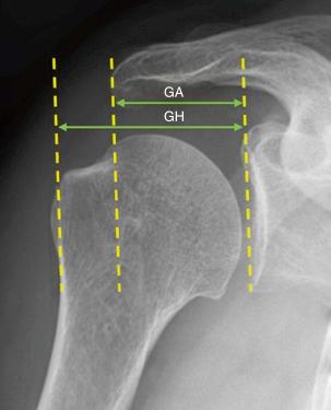 FIG. 19.5, The acromion index is measured on a true anteroposterior radiograph. The distance between the glenoid plane and the lateral aspect of the acromion (GA) is divided by the distance between the glenoid plane and the lateral border of the proximal humerus (GH) .