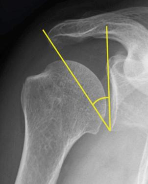 FIG. 19.6, The critical shoulder angle is determined on a true anteroposterior radiograph by measuring the angle between the glenoid plane and the lateral aspect of the acromion.