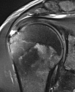 FIG. 19.7, T2-weighted coronal magnetic resonance imaging showing a full-thickness tear of the supraspinatus tendon. The tendon integrity is interrupted close to the greater tuberosity resulting in a space filled by fluid.