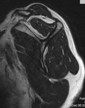 FIG. 19.8, T1-weighted sagittal magnetic resonance imaging is used to accurately assess the muscle quality by determining the fatty infiltration and atrophy.