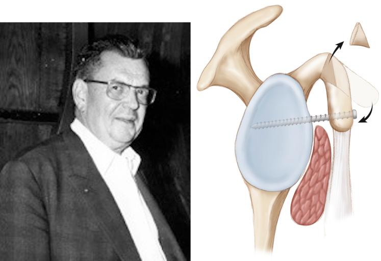 FIG. 35.1, The man (Albert Trillat) and the operation. After a closed-wedge osteotomy, the coracoid process is tilted downward and medial. It is then fixed onto the glenoid neck with a nail (or a screw) placed above the subscapularis.