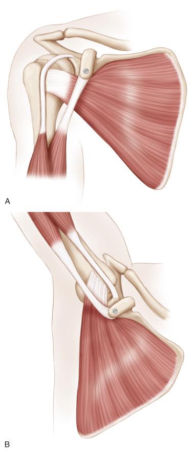 FIG. 35.2, Rationale of the Trillat procedure. (A) The conjoint tendon is displaced distally, medially, and posteriorly (closer from the glenohumeral joint line), whereas the subscapularis is lowered. (B) This provides a “sling effect” or “seat belt effect” preventing anterior dislocation and pushing the humeral head backward in the “at-risk position” (i.e., the throwing position).