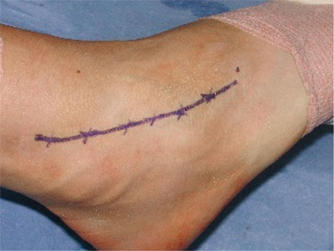 Fig. 39-11, Superficial peroneal nerve is marked in this right ankle before applying the ankle distractor.