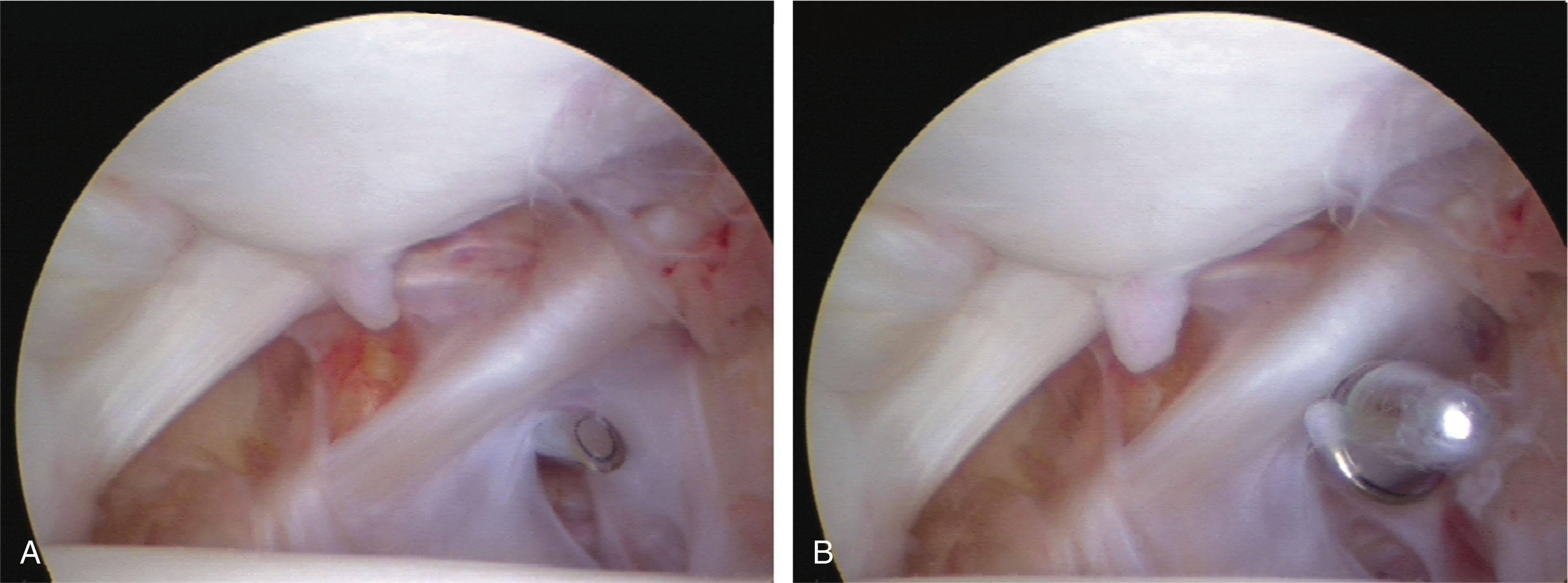 Fig. 39-13, Posterolateral portal. A , The posterolateral portal is usually established under the transverse tibiofibular ligament, lateral to the flexor hallucis longus capsular reflection using a spinal needle. B , A cannula is then inserted and inflow or instrumentation is used.