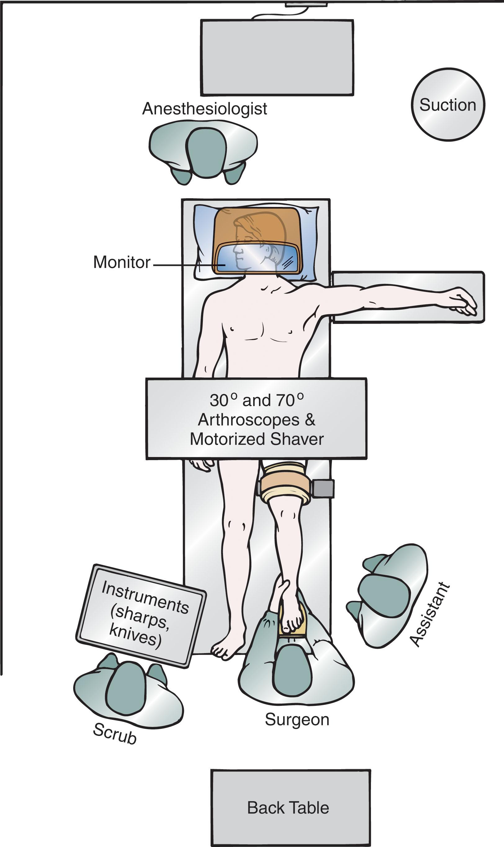 Fig. 39-16, Overhead view of the operative setup showing the typical arrangement of the anesthesiologist, surgeon, assistant, scrub nurse, and various surgical stands and tables, as well as the video equipment.