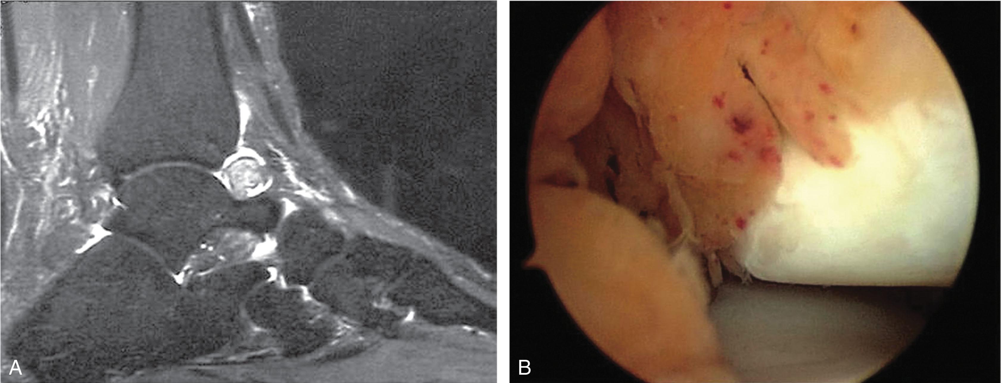 Fig. 39-17, Tenosynovial giant cell tumor (pigmented villonodular synovitis). A , Sagittal T2 magnetic resonance image showing large synovial nodules anterior to ankle with an effusion. B , Arthroscopic picture showing hemosiderin staining of inflamed synovium with papillary formation.