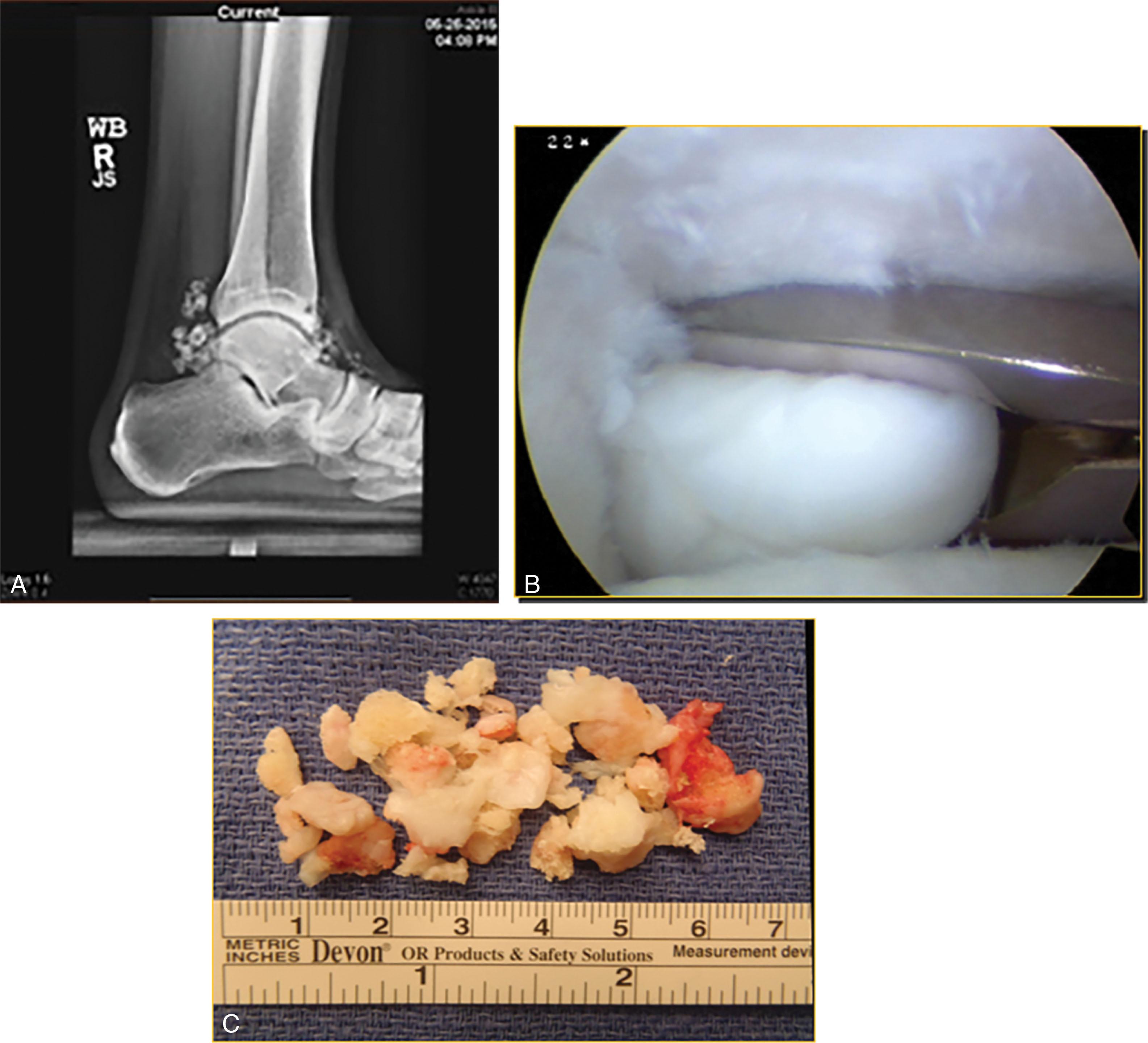 Fig. 39-18, Synovial chondromatosis. A , Anteroposterior radiograph demonstrating multiple loose bodies. B , Arthroscopic picture showing numerous loose bodies within the ankle. C , Postoperative picture demonstrating large number of loose fragments removed.