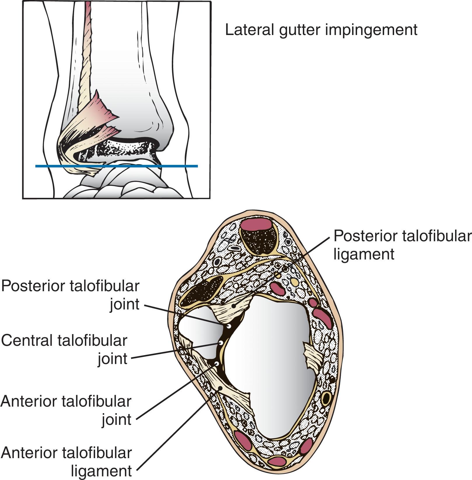 Fig. 39-20, Cross section through talus demonstrates lateral gutter anatomy.