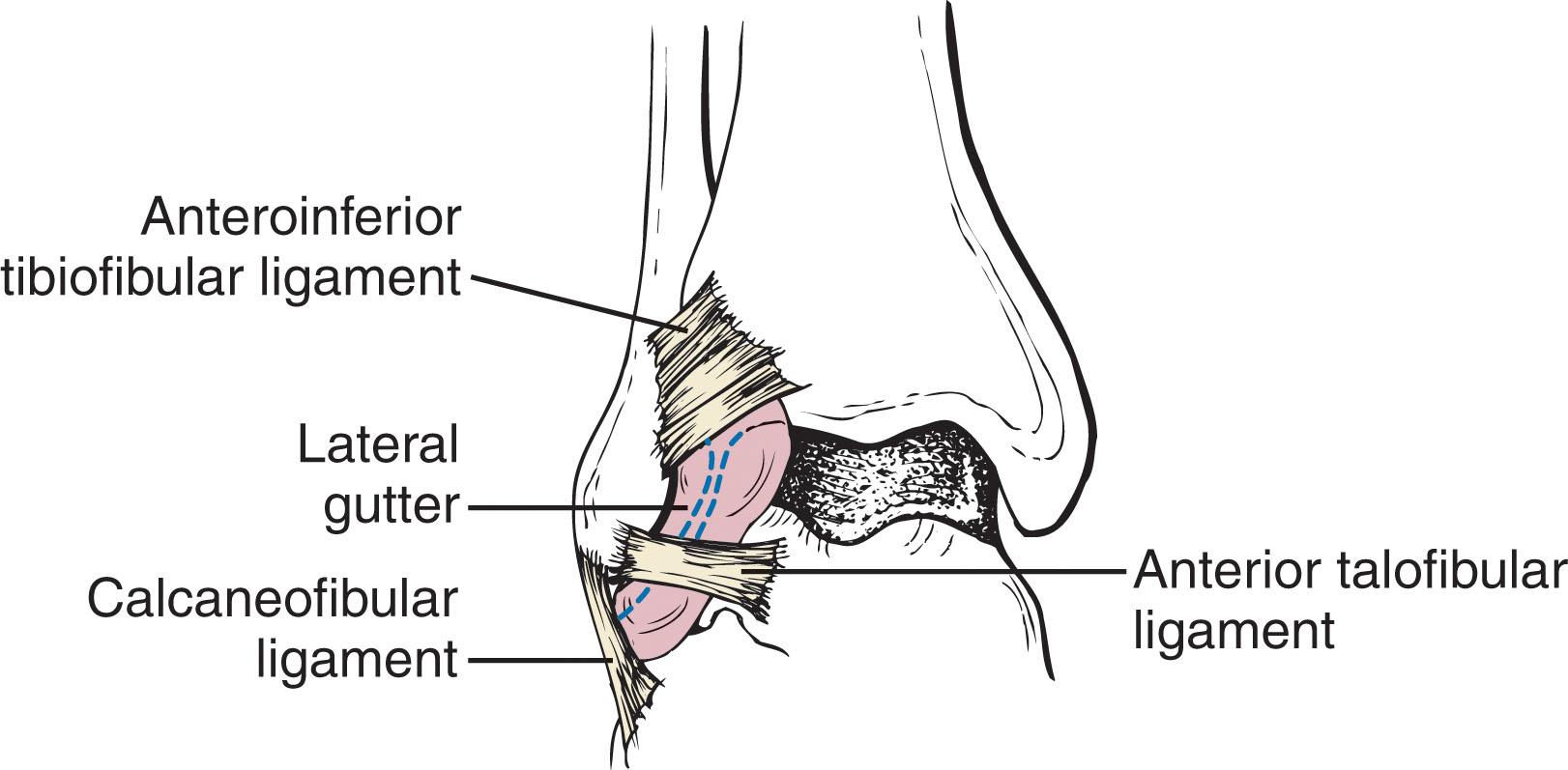 Fig. 39-21, Anterior anatomy of the lateral gutter. This space is bordered by bone, capsular, and ligamentous structures.