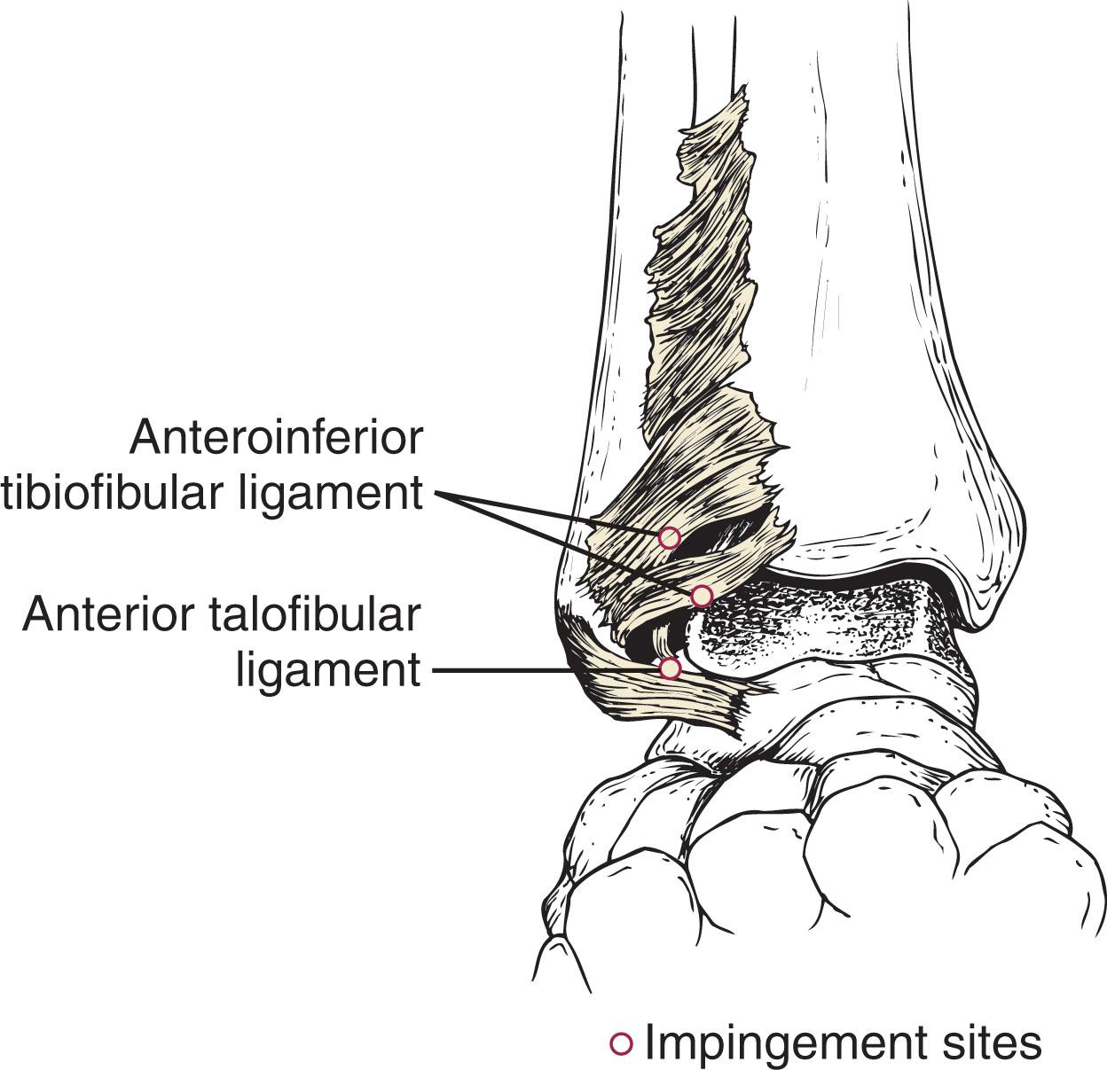 Fig. 39-23, Anterior impingement sites. Note that anteroinferior tibiofibular ligament might have a separate fascicle that can impinge against the lateral dome of the talus.