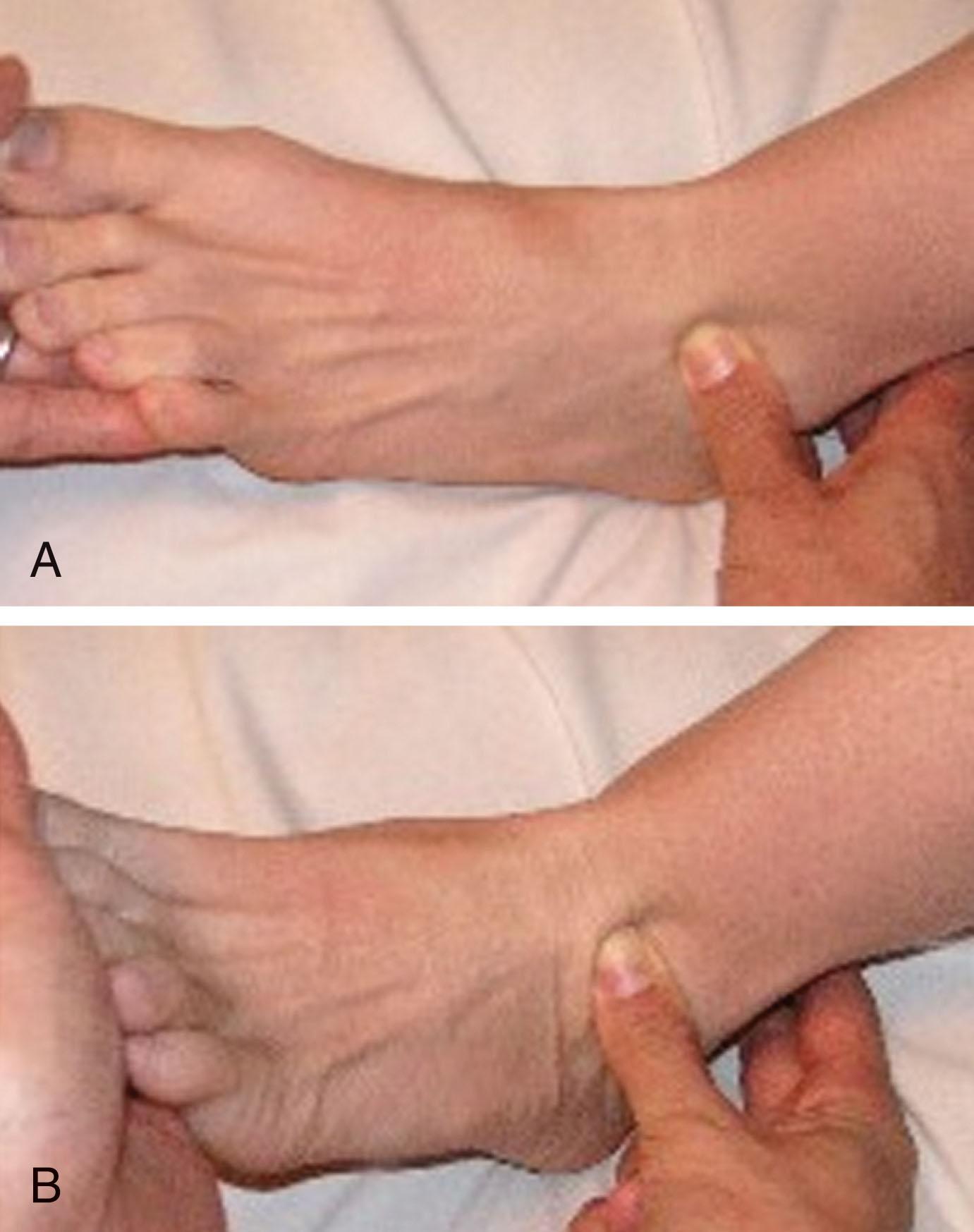 Fig. 39-25, Examination of anterolateral impingement. Pain with palpation over the anterior talofibular ligament (A) is increased with ankle dorsiflexion (B) .