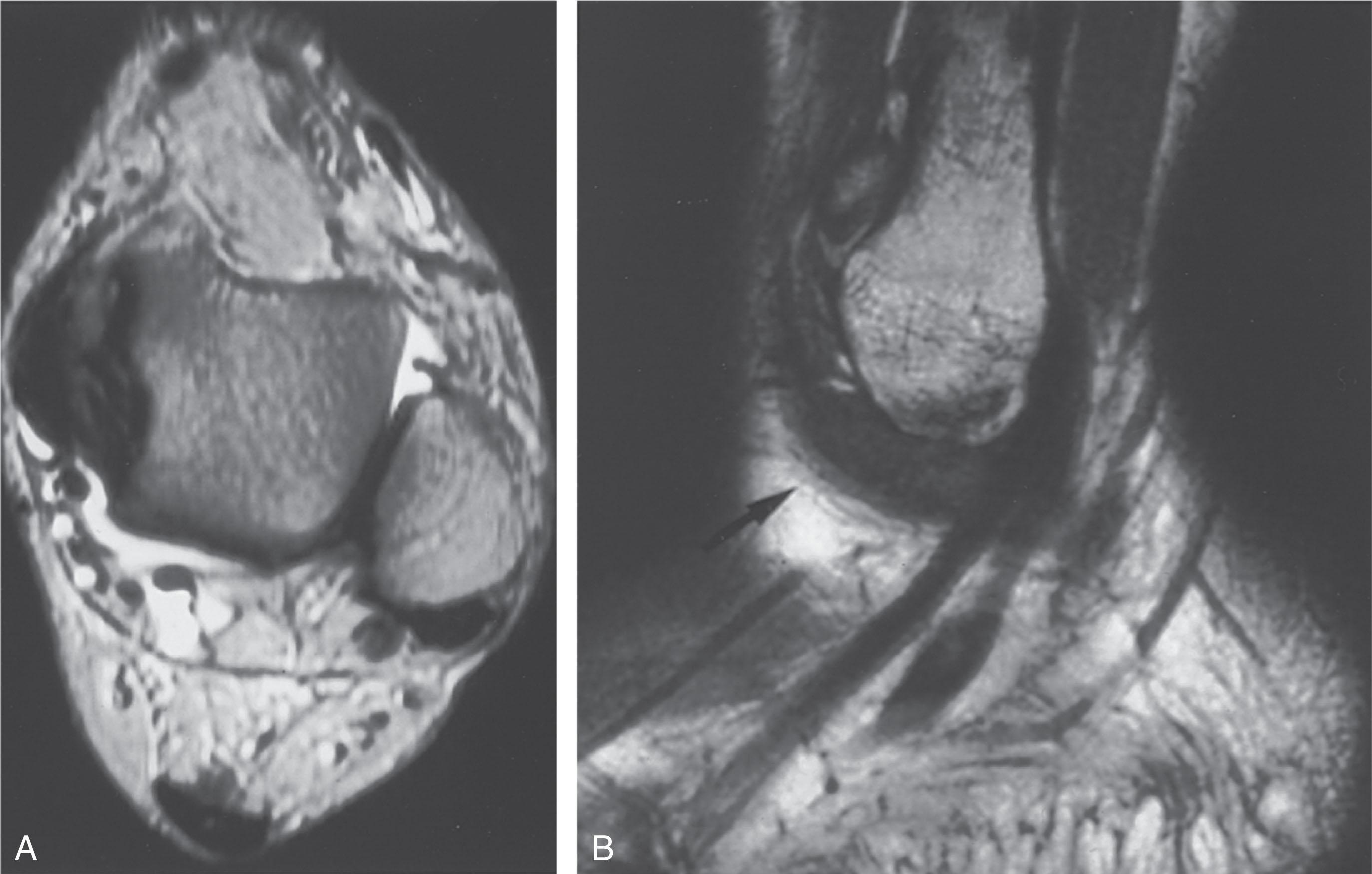 Fig. 39-26, Magnetic resonance imaging scans of the ankle. A , Axial T2-weighted image shows fluid in the lateral gutter with a torn remnant of the syndesmotic ligament. B , Sagittal T1-weighted image demonstrates low signal density mass in anterolateral gutter (arrow) , consistent with soft tissue impingement.