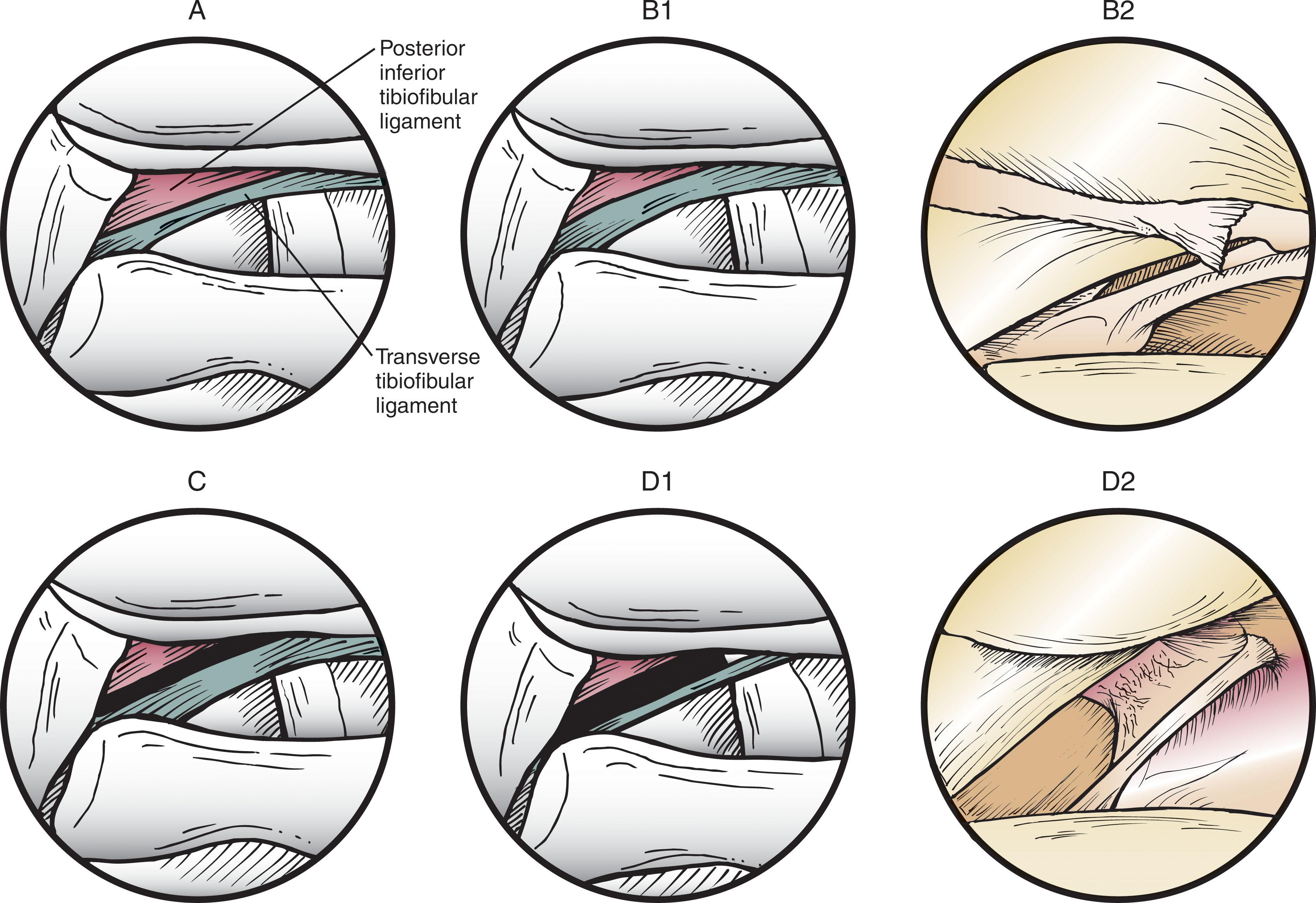 Fig. 39-28, Subtypes of posterior inferior tibiofibular ligament (PITFL) and transverse tibiofibular ligament (TTL) in a right ankle. A , Type I, with a confluence of the PITFL and TTL without discernible separation. B1 , Type II with less than a 2-mm separation between the PITFL and TTL. B2 , Arthroscopic view of type II configuration. C , Type III with a 2-mm or larger gap between the PITFL and TTL. D1 , Type IV pattern with a sizable gap and a cordlike TTL with a notable thinning of the posterior labrum. D2 , Arthroscopic view of type IV configuration. It is unclear if this ligament is truly the TTL or a tibial slip (intermalleolar ligament) occurring in the absence of a true ligament.