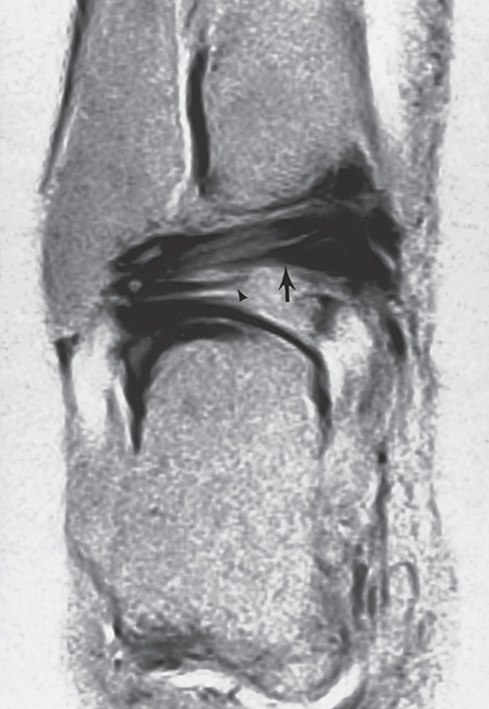 Fig. 39-29, Magnetic resonance image demonstrates a tibial slip (intermalleolar ligament) (large arrow) . The tibial slip runs from posterior talofibular ligament (arrowhead) to transverse tibiofibular ligament.