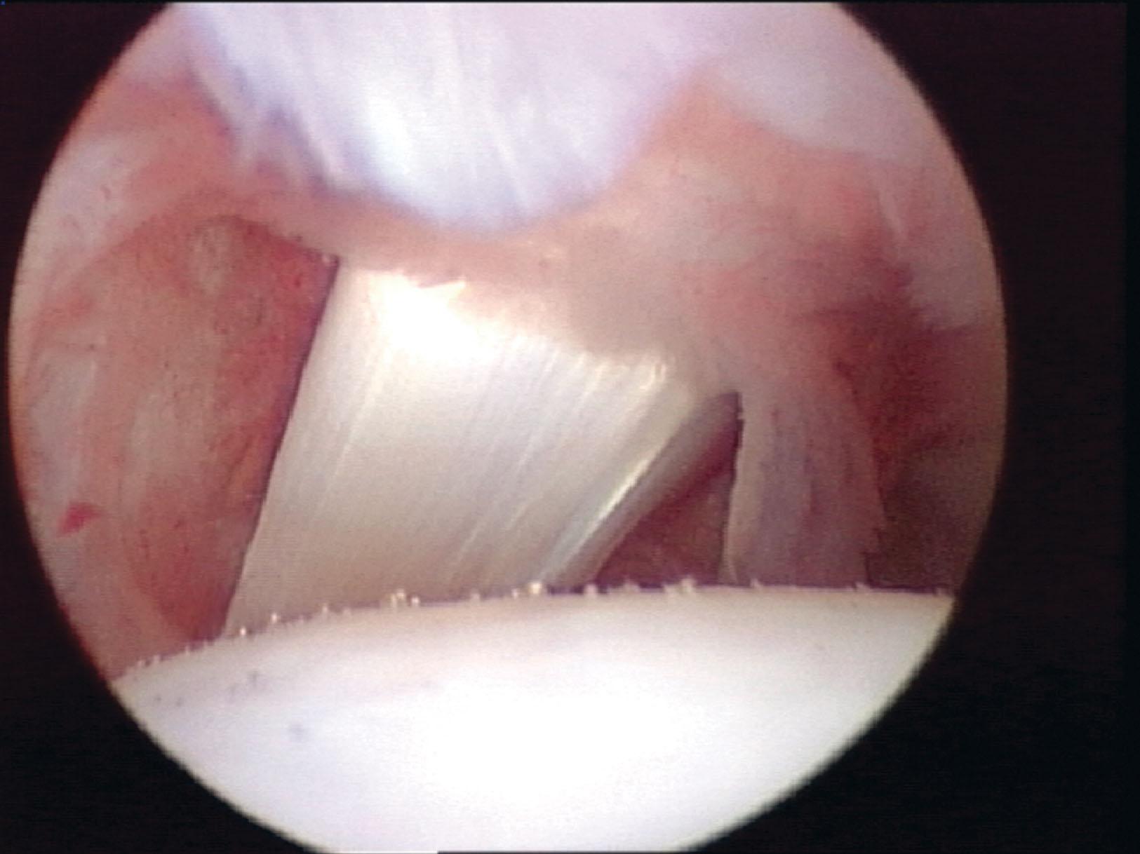 Fig. 39-30, Arthroscopic view of the flexor hallucis longus traversing the posterior capsule. Visualization is from the anteromedial portal.