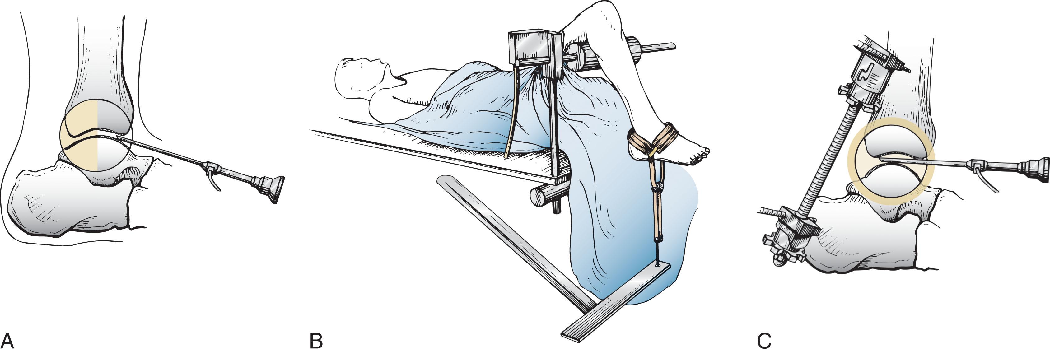 Fig. 39-3, Lateral views of ankle during arthroscopic examination. A , Without distraction. B , With controlled, noninvasive distraction device. C , With invasive distraction device.