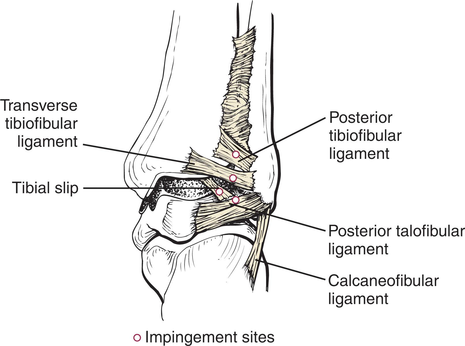 Fig. 39-31, Posterior ankle impingement sites. Note direction and orientation of the tibial slip.