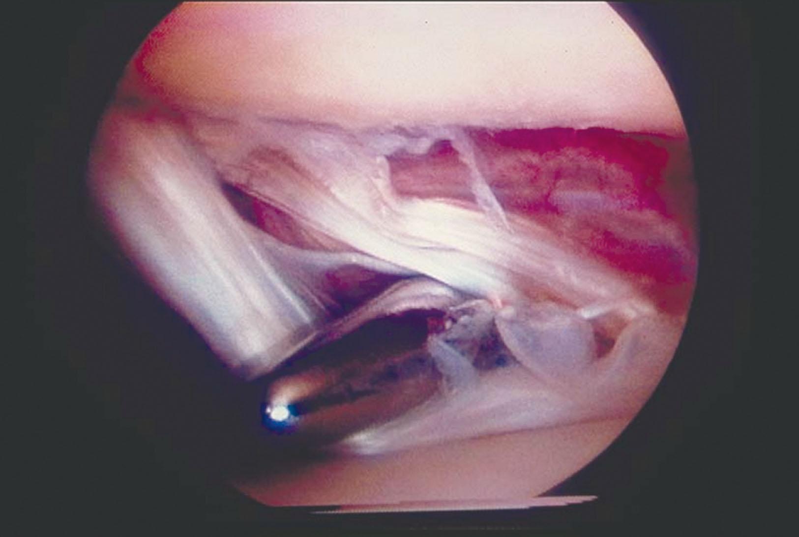 Fig. 39-32, Arthroscopic view of a longitudinal tear of the transverse tibiofibular ligament as seen from the anteromedial portal.