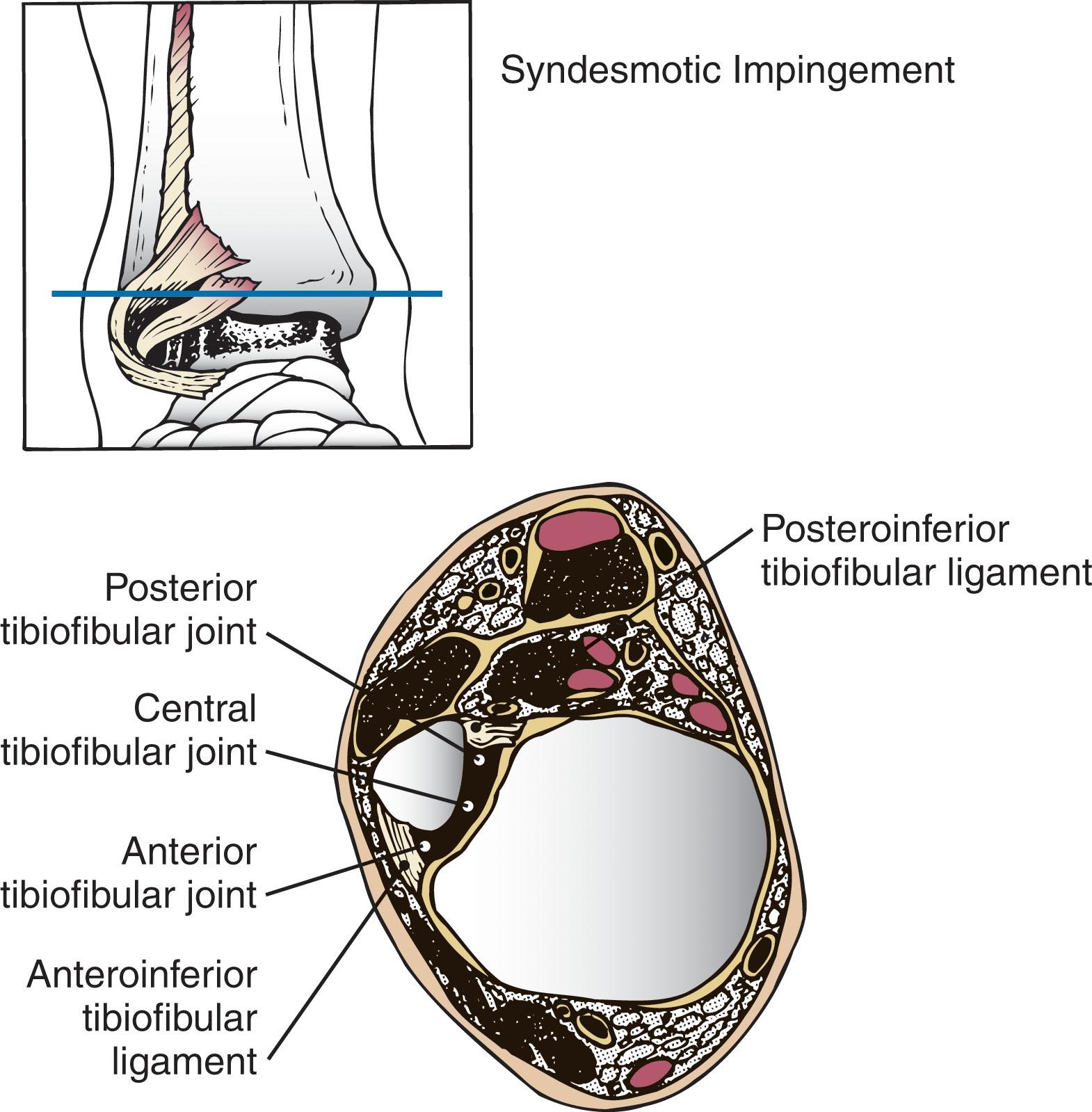 Fig. 39-33, Syndesmotic impingement. Cross-sectional anatomy through the syndesmosis demonstrates confines of the lateral gutter at this level.