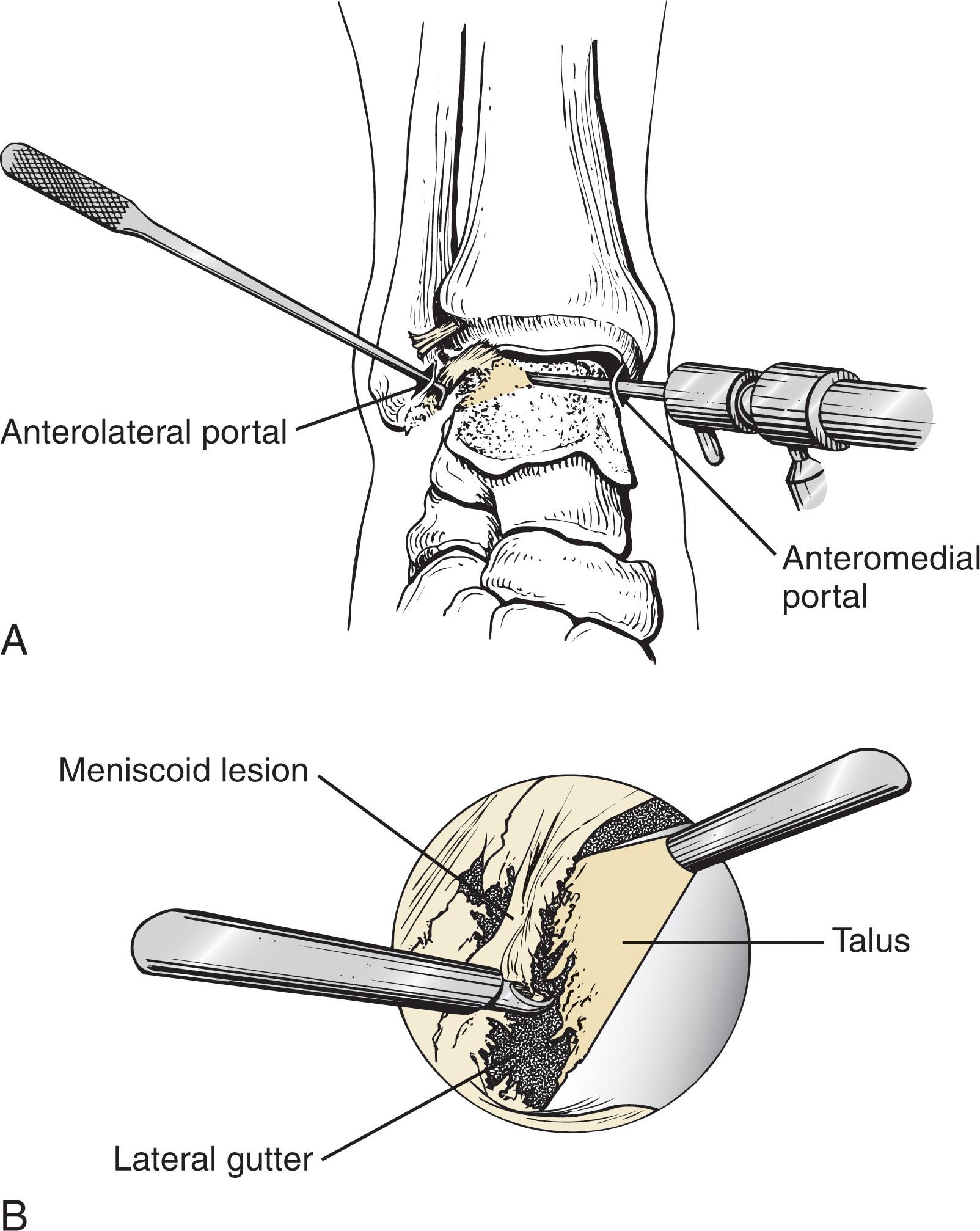 Fig. 39-35, A , Anterolateral soft tissue impingement. Probe is palpating synovitis and fibrosis of the anterolateral gutter. B , Synovectomy and debridement of the lateral gutter with a 2.9-mm full-radius shaver.