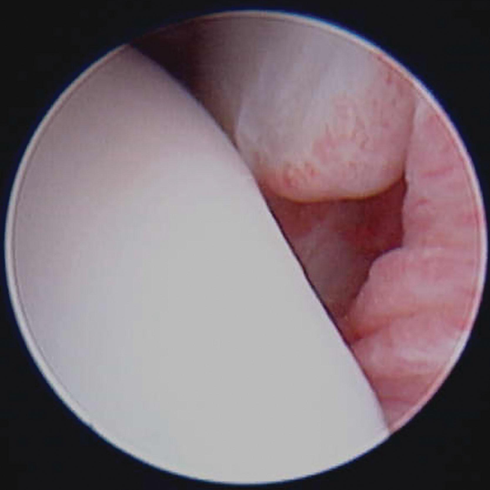 Fig. 39-36, Arthroscopic view of the soft tissue impingement of the anterolateral lateral gutter as seen from the anteromedial portal.