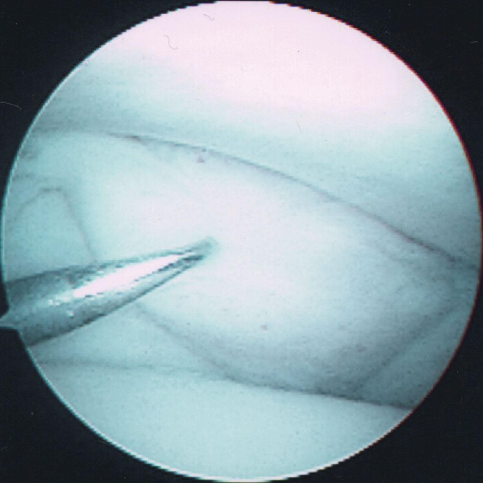 Fig. 39-37, Arthroscopic view of the syndesmosis from the anteromedial portal showing hypertrophic synovial tissue at the tip of the probe.