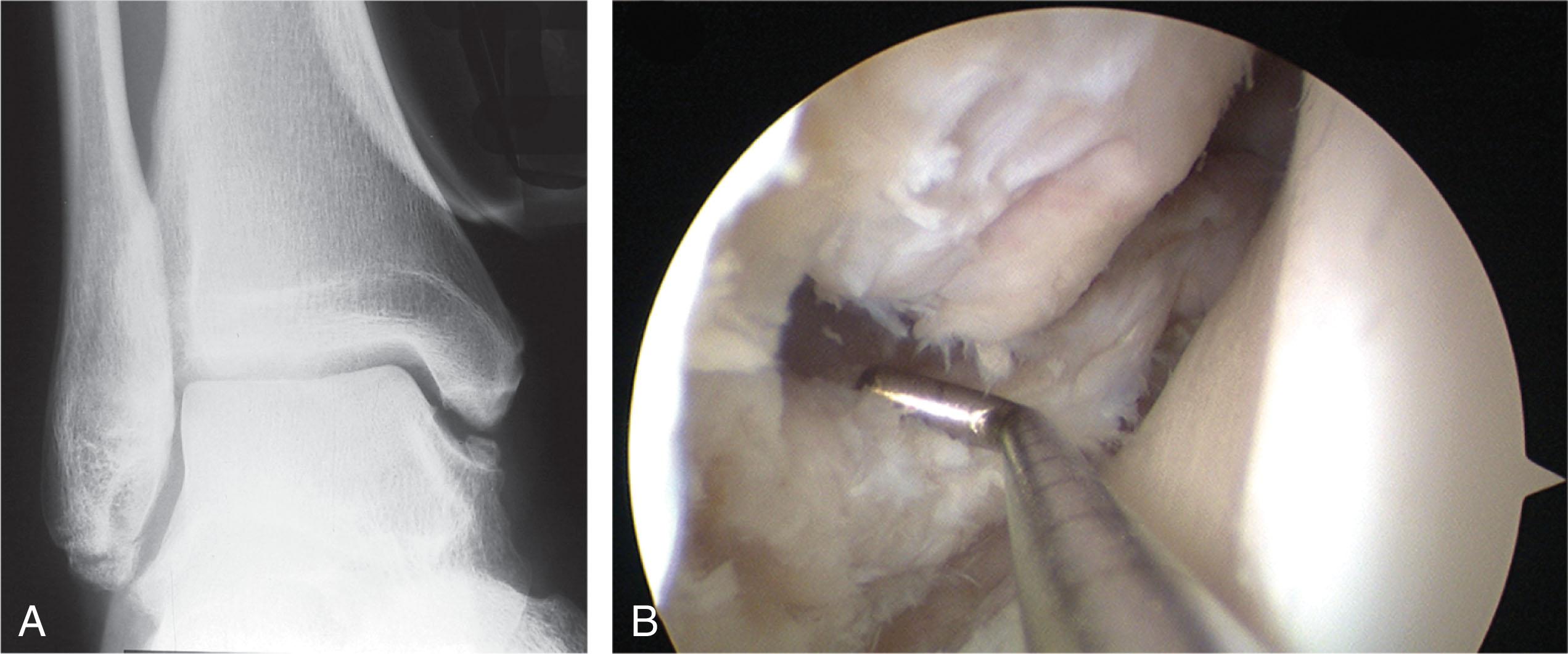 Fig. 39-38, Distal fibular ossicles in a right ankle. A , Radiograph shows ossicle is scarred to the tip of the fibula. B , Arthroscopic picture shows nonunion of the fragment that is attached to the anterior talofibular ligament.