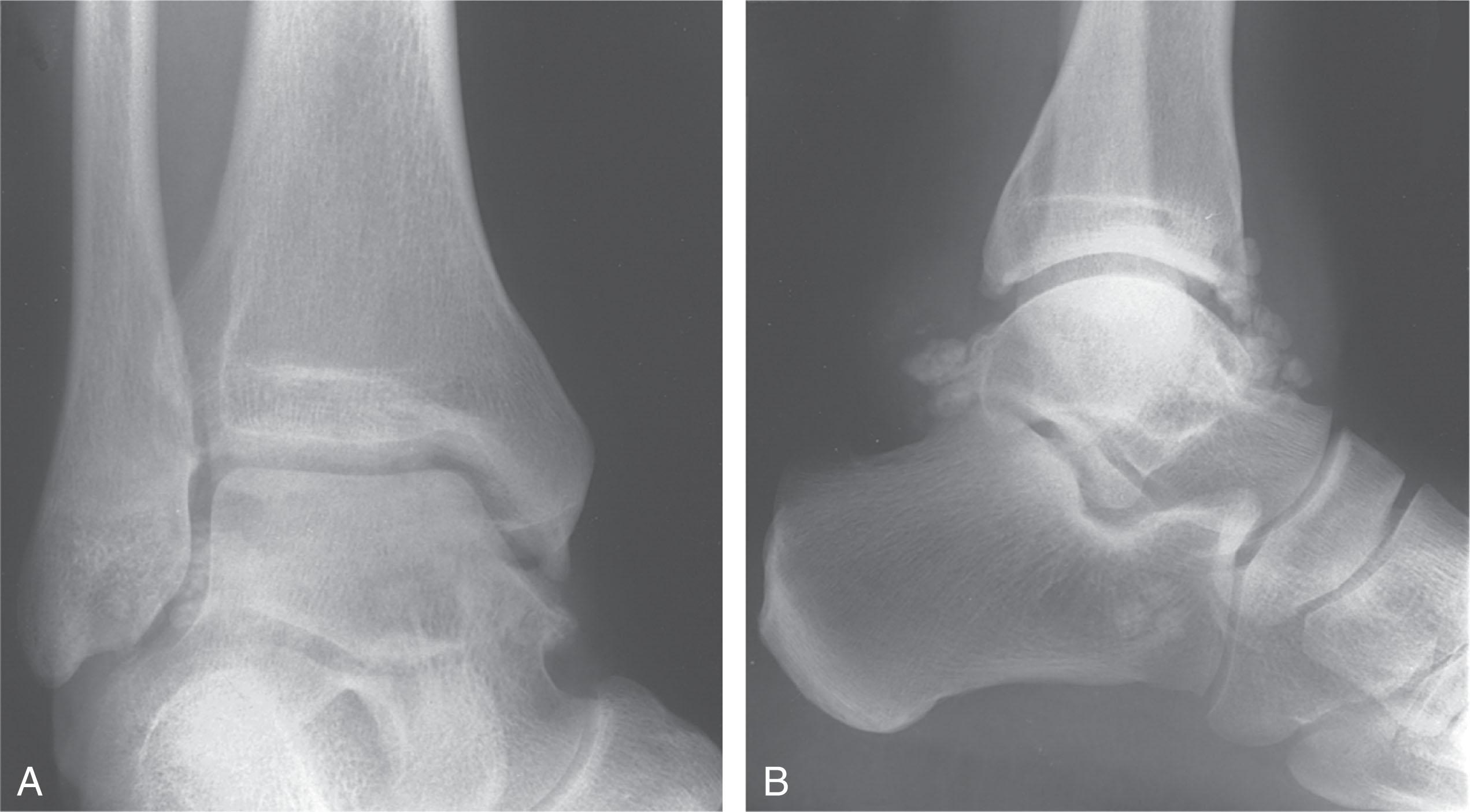 Fig. 39-39, Synovial osteochondromatosis of the ankle. A , Anteroposterior view. B , Lateral view.