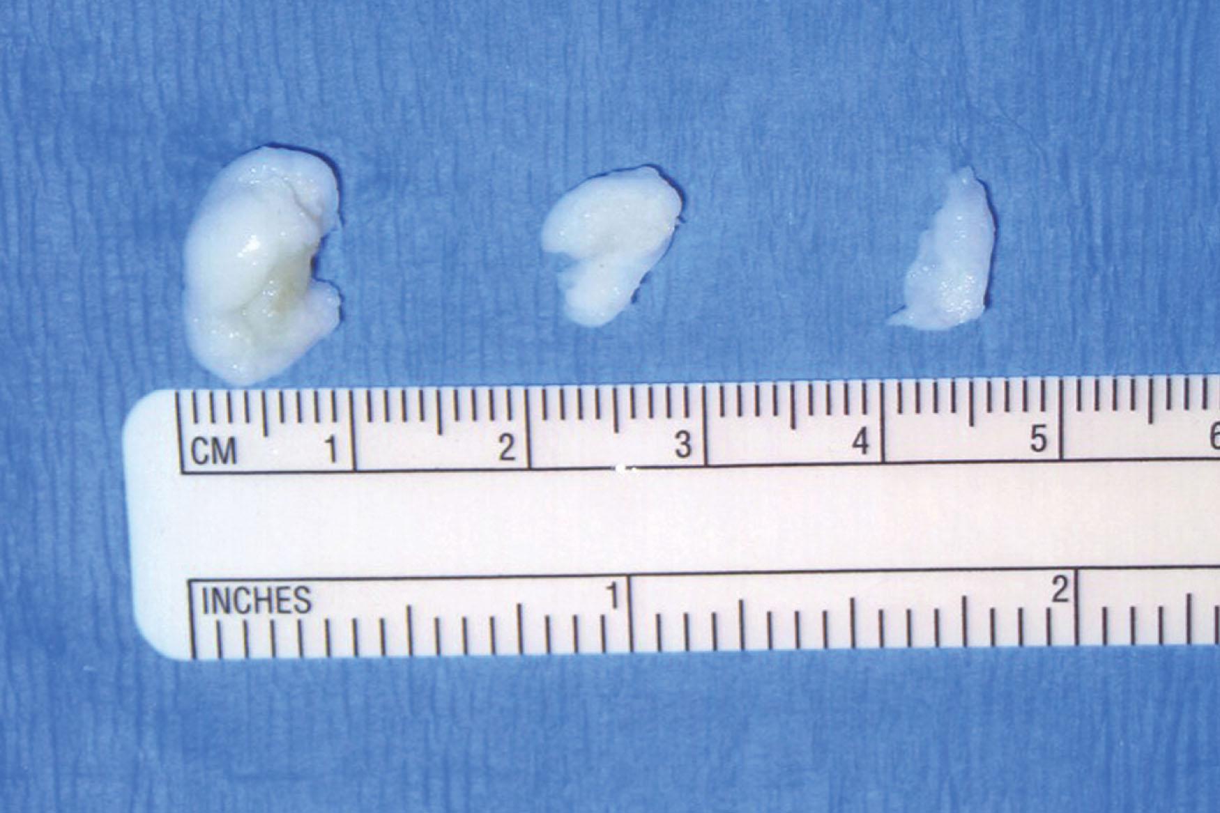 Fig. 39-40, Loose bodies removed arthroscopically from the ankle. Given their size, the arthroscopic portal was enlarged to avoid having the loose body become entrapped in the subcutaneous tissue.