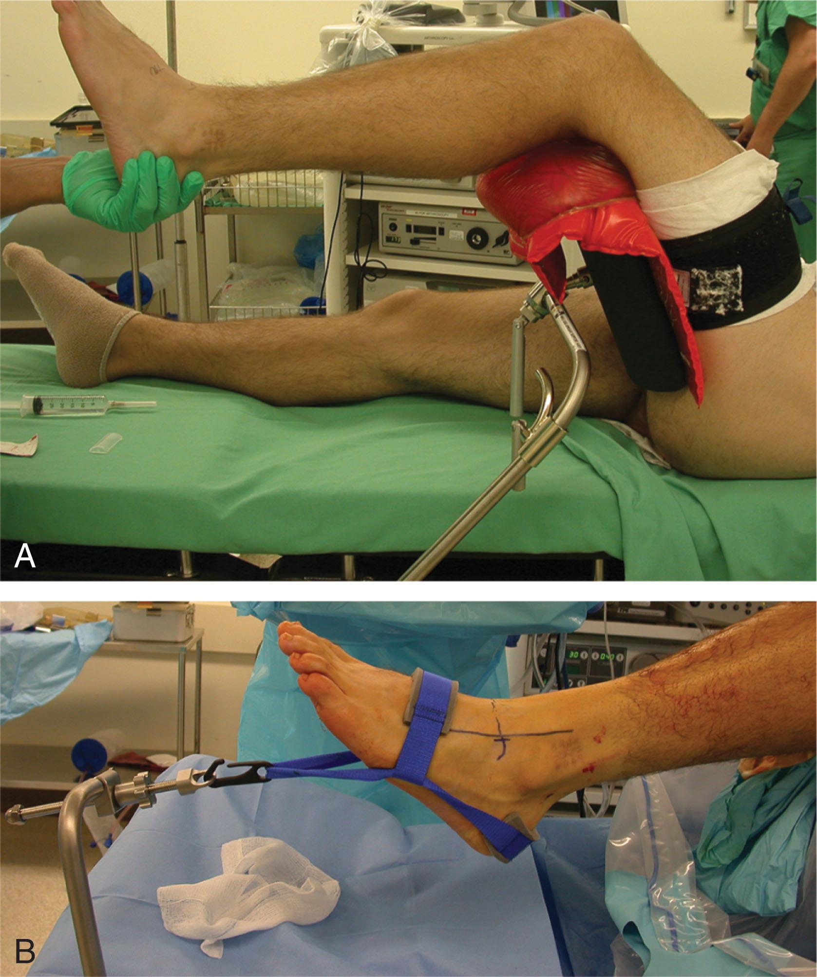 Fig. 39-4, Noninvasive ankle distraction. A , Padded thigh stirrup is applied to the table’s side-rail to flex the hip approximately 45 to 60 degrees. B , A soft tissue distraction strap is attached to the table with a sterile clamp attached to side rail.