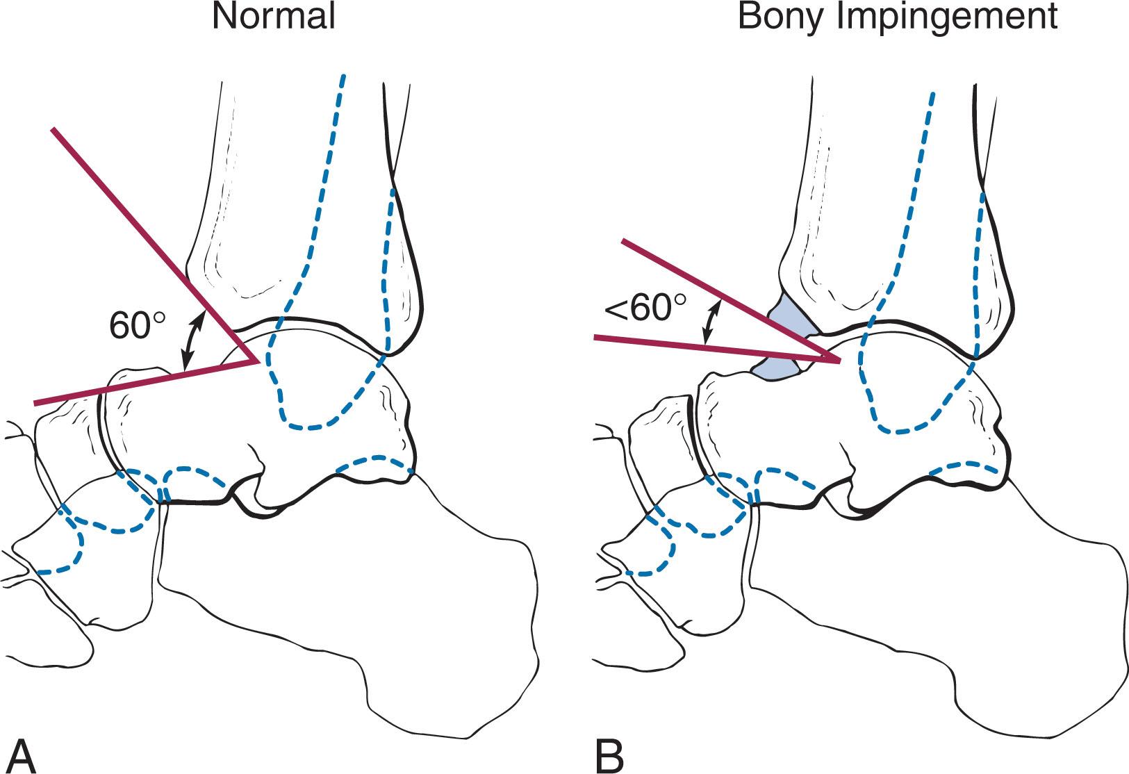 Fig. 39-44, A , Normal angle between the distal tibia and the talus is 60 degrees or greater. B , Osteophytic formation on the distal tibia and talar neck with angle decreased to less than 60 degrees.