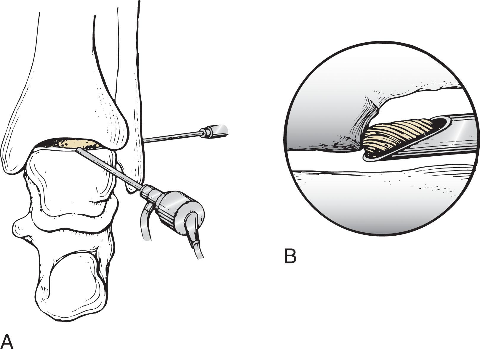 Fig. 39-45, Excision of anterior osteophyte through posterolateral visualization. A , Anterior overhang of the osteophyte is well visualized through the posterolateral portal. B , The osteophyte can be excised with a motorized burr or osteotome.