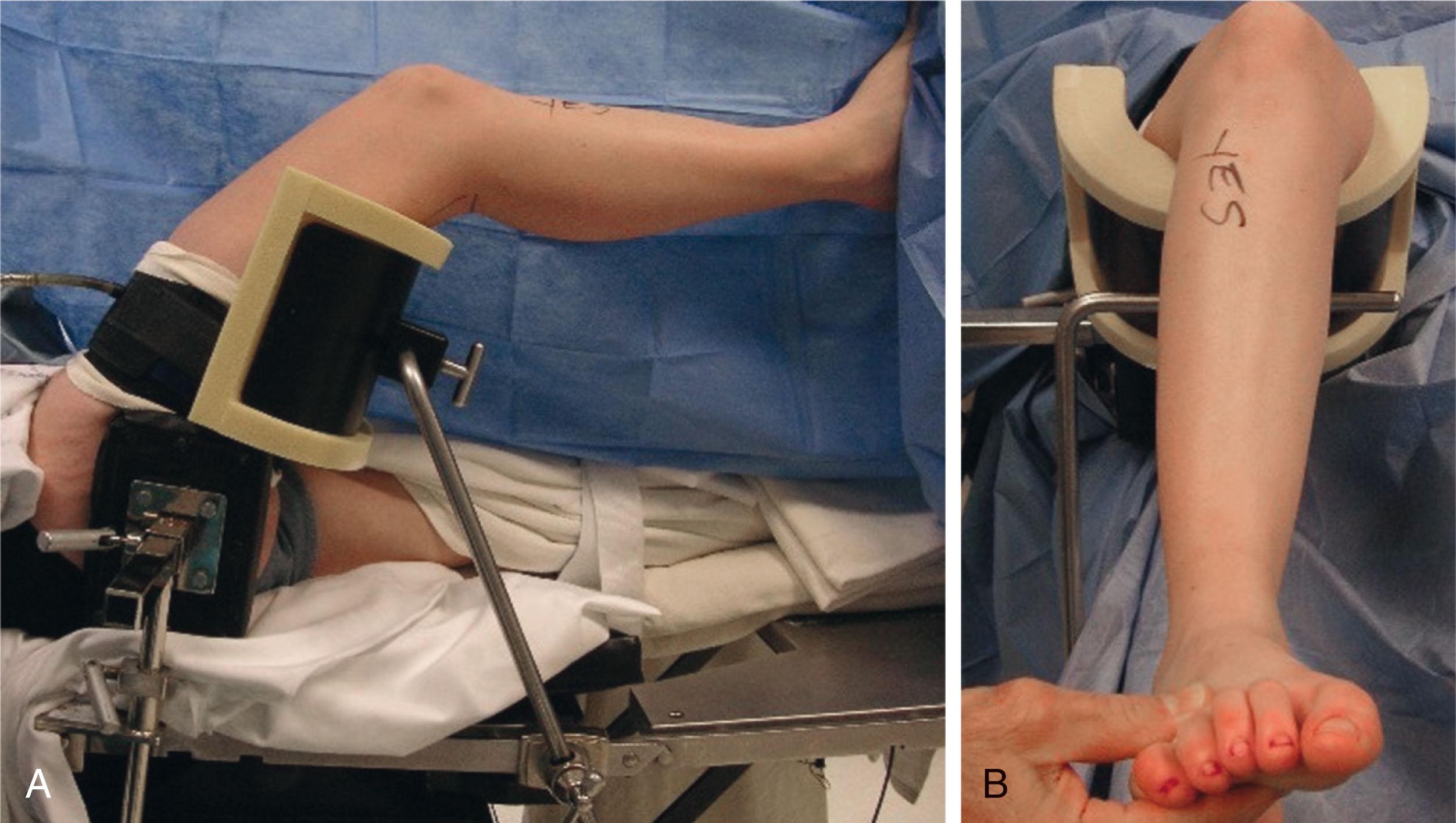 Fig. 39-5, Author's preferred positioning. A , The thigh is supported by a well-padded holder attached via a clamp to the rail of the table. A tourniquet is placed around the proximal thigh. The nonoperative extremity is well padded and kept straight on the table. B , The ankle is oriented in a neutral position by internally rotating the pelvis against a side post at the level of the greater trochanter.