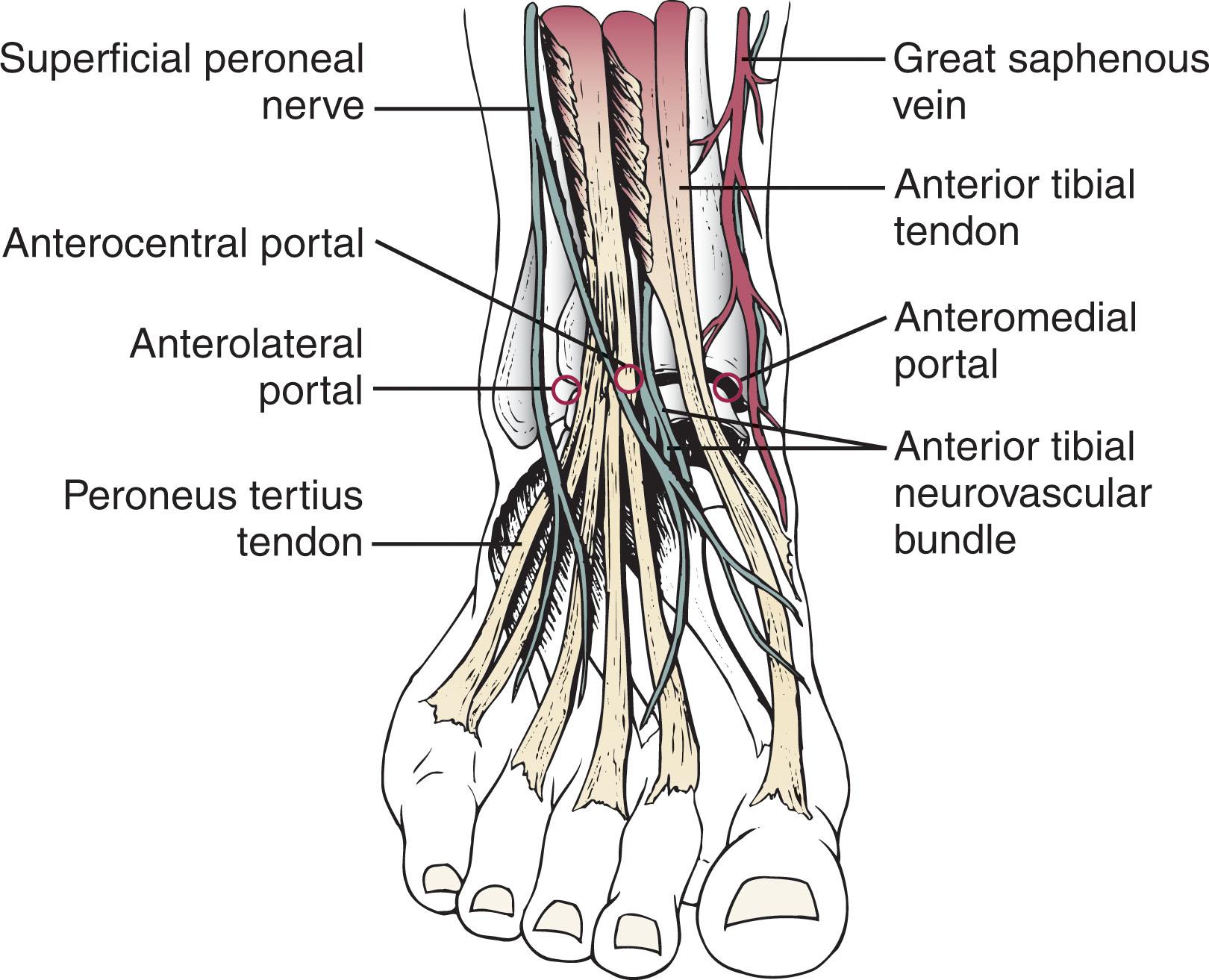 Fig. 39-6, Three anterior portals used for ankle arthroscopy. The anterocentral portal is rarely used.