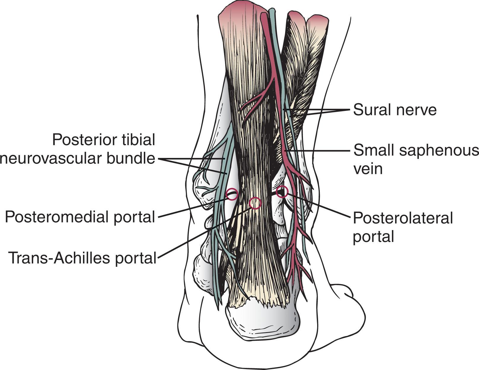 Fig. 39-7, Three posterior portals used for ankle arthroscopy. The posterolateral portal is the most often used.