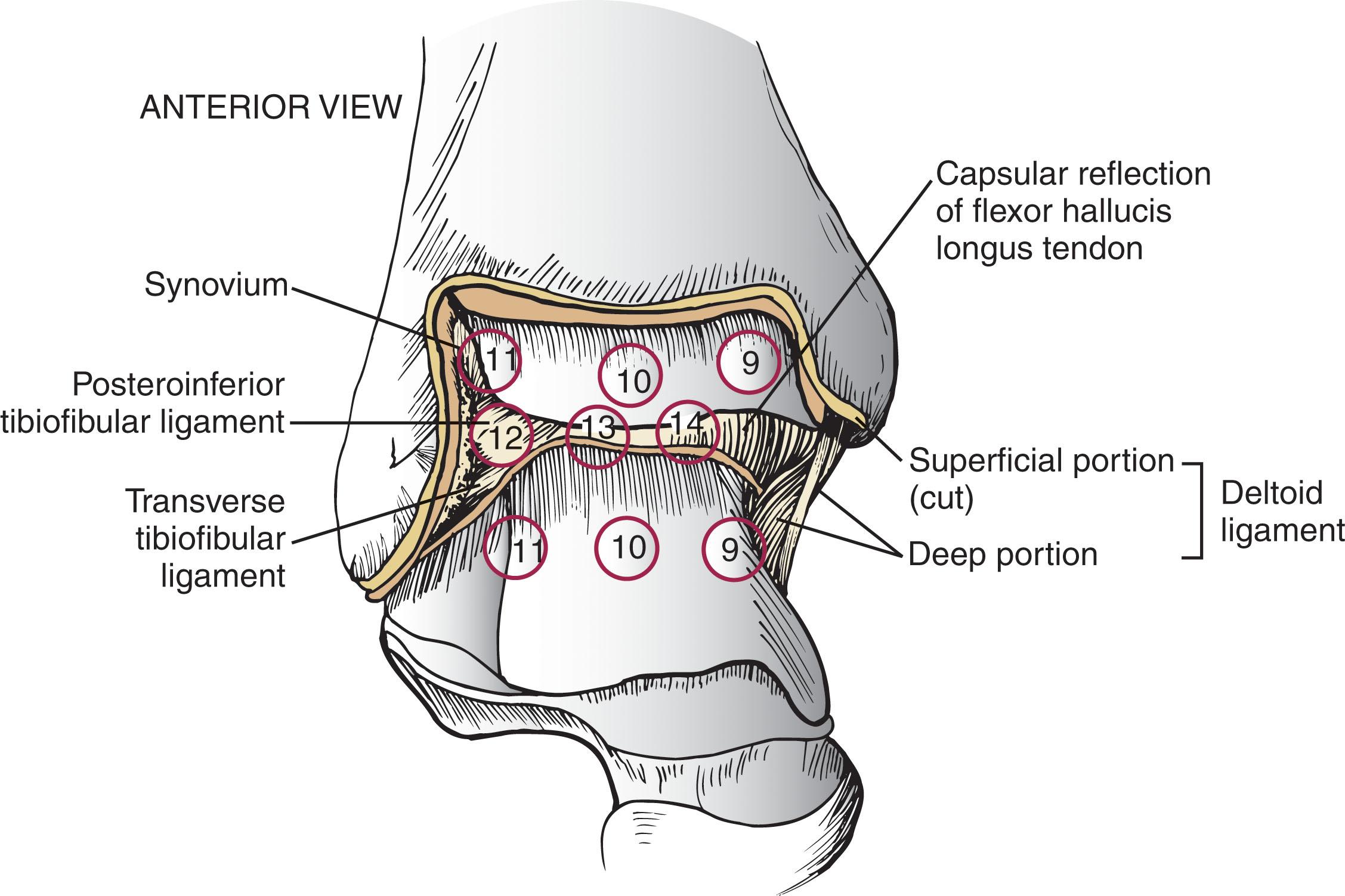 Fig. 39-9, Six-point central ankle examination through the arthroscope (viewed from anteromedial portal). Central examination is performed by maneuvering the arthroscope into the center of the ankle and examining the tibiotalar articulation (areas 9, 10 , and 11 ). The arthroscope is then placed more posteriorly to examine the posterior capsular structures (areas 12, 13 , and 14 ).