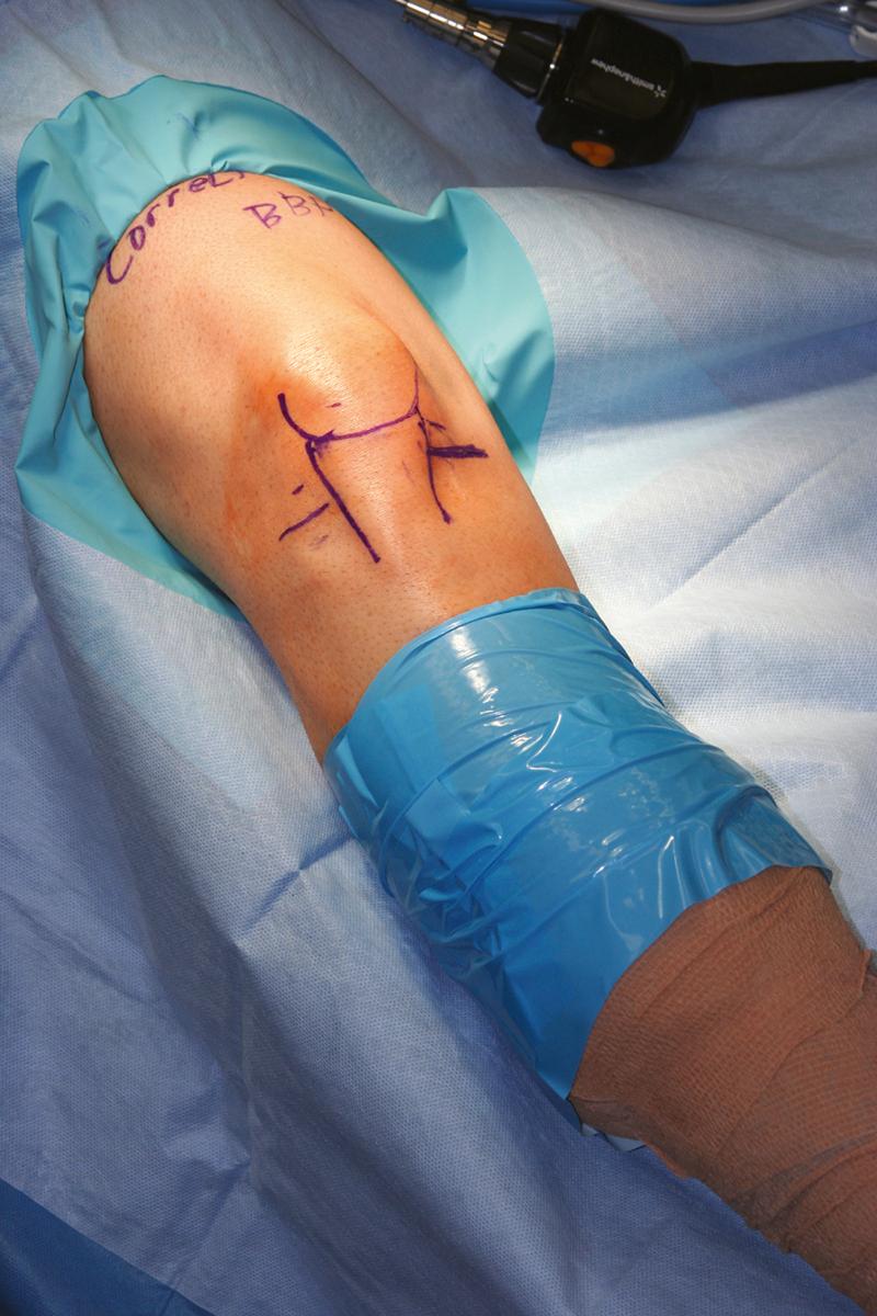 FIGURE 51.4, Landmarks drawn on knee before distention.