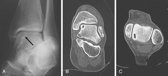 Fig. 119.1, (A) A posteromedial osteochondral lesion of the talus (arrow) . (B) A coronal plane computed tomography (CT) image. (C) An axial plane CT image.