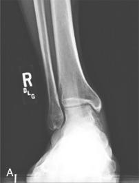 Fig. 119.2, (A) Plain radiographs, (B) computed tomography, and (C) magnetic resonance imaging appearance of a displaced (stage 4) osteochondral lesion of the talus. Note the bone marrow edema visible on the talus and tibia on magnetic resonance imaging.