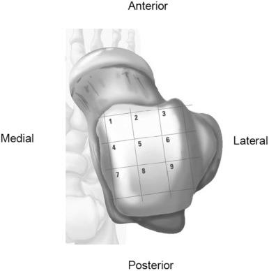 Fig. 119.3, Zones of osteochondral lesions of the talus based on a grid scheme.