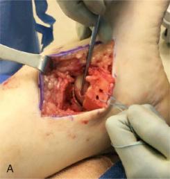 Fig. 119.4, Medial or lateral malleolar osteotomy often is necessary for treatment of posteriorly oriented osteochondral lesions of the talus (OLT) or large OLT (treated with osteochondral autologous transplantation or bulk allograft). The authors’ preferred medial malleolar osteotomy is a chevron osteotomy (A) fixed with two 4.0-mm partially threaded cannulated screws (B).