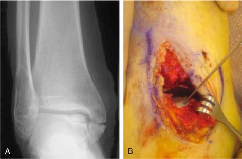 Fig. 119.5, (A) An acute osteochondral lesion of the talus associated with an ankle fracture. (B) Kirschner wire was used to predrill for placement of an absorbable pin. (C) Completed fixation.