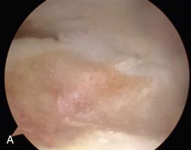 Fig. 119.6, Technique for arthroscopic particulate juvenile articular cartilage implantation. (A) The bed of the osteochondral lesion is prepared with usual débridement and curettage. The joint is cleared of arthroscopy fluid and the bed of the osteochondral lesion is dried. (B) The base fibrin glue layer is placed at the bony base of the osteochondral lesion. (C) The particulated juvenile cartilage is delivered through a cannula. (D) The cartilage layer is smoothed and spread with a Freer elevator or appropriate tool. (E) The particulated juvenile cartilage is sealed with another layer of fibrin glue and allowed to set.