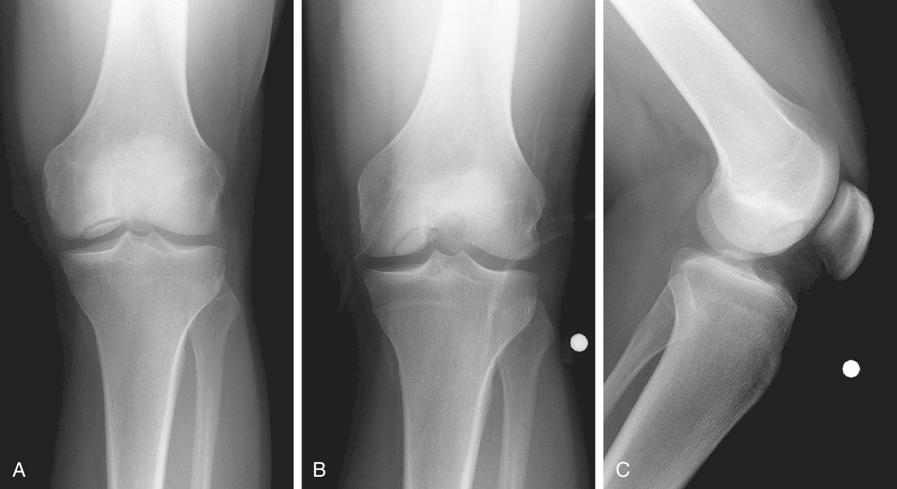 FIG 28.1, Radiograph of an Osteochondritis Dissecans (OCD) Lesion in the Classic Location of the Lateral Aspect of the Medial Femoral Condyle (MFC)