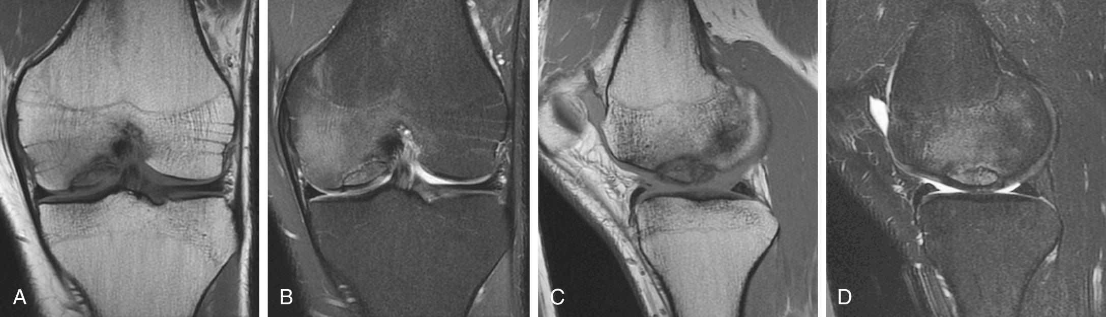 FIG 28.2, Magnetic Resonance Imaging (MRI) of an Osteochondritis Dissecans (OCD) Lesion at the Lateral Aspect of the Medial Femoral Condyle (MFC)