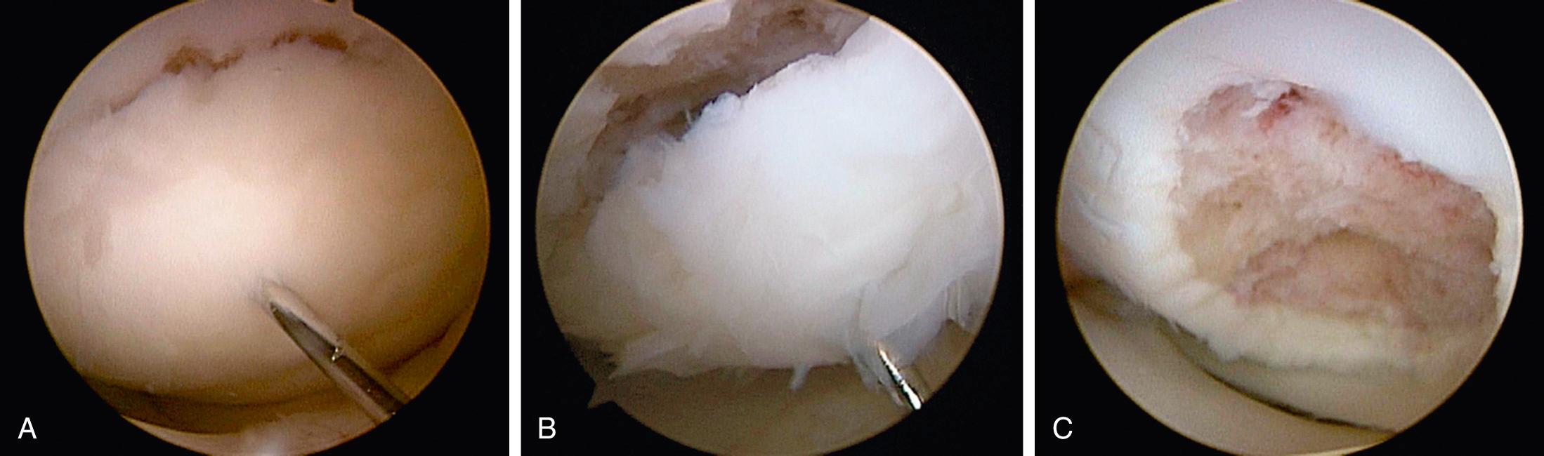 FIG 28.4, Unstable Osteochondritis Dissecans (OCD) Fragment