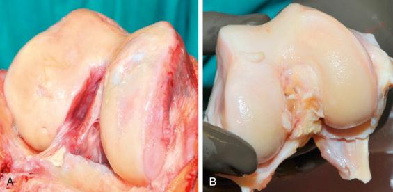 Fig. 73.1, Severe bicondylar cartilage damage at the knee. (A) Grade IV cartilage damage in the area of the medial femoral condyle, the trochlea, and the medial tibial plateau, with destruction of the medial meniscus. (B) Fresh, not-yet-prepared distal femur transplant before cutting.