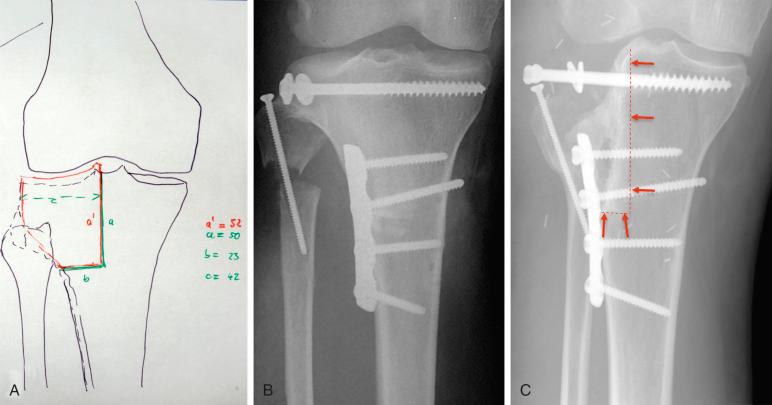 Fig. 73.2, Natural history after transplantation of a massive (50 × 23 × 42 mm 3 ) frozen osteochondral transplant in a 35-year-old patient after resection of a G1 chondrosarcoma of the lateral tibial plateau. (A) Preoperative planning ( red-green line: resection plane); (B) Radiograph after resection and transplantation of a large frozen allograft; (C) Radiograph after 5 years. The graft is almost but not completely resorbed. The red arrows and dashed line mark the initial resection line, demonstrating a 6- to 8-mm zone with integrated transplant bone.